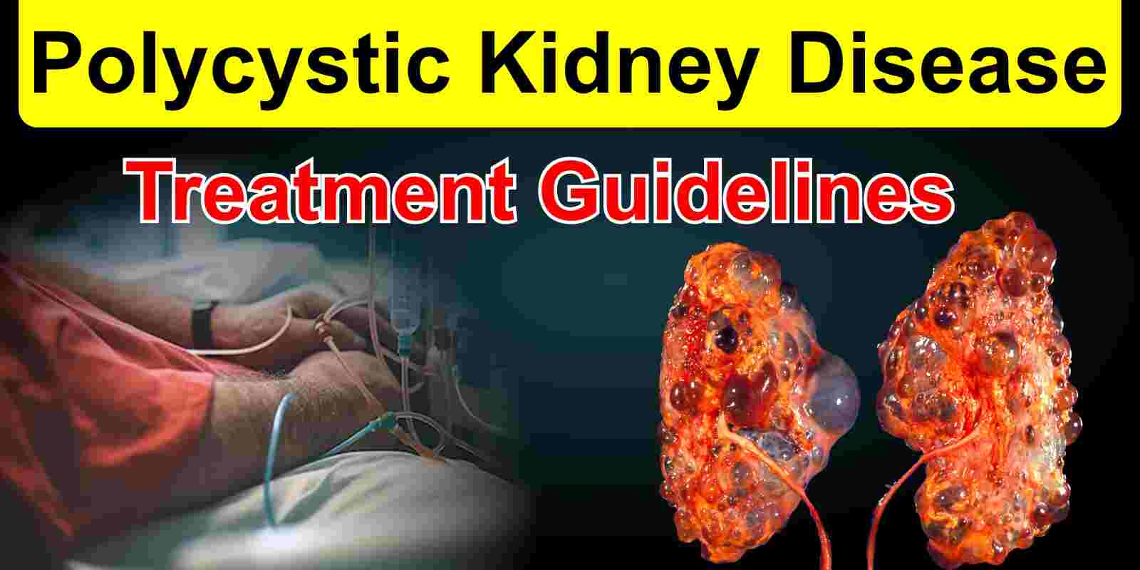 Polycystic Kidney Disease Treatment Guidelines